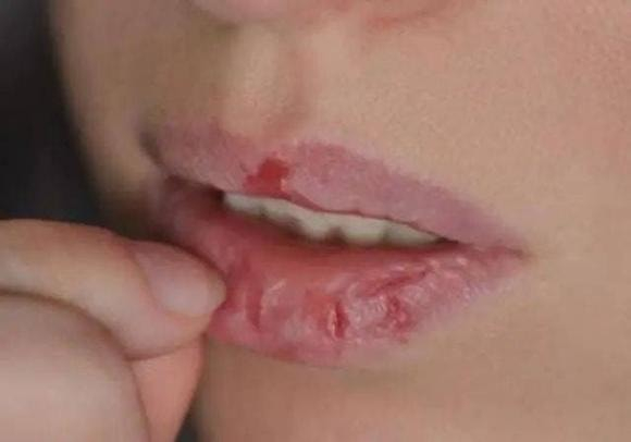 lips peel continuously