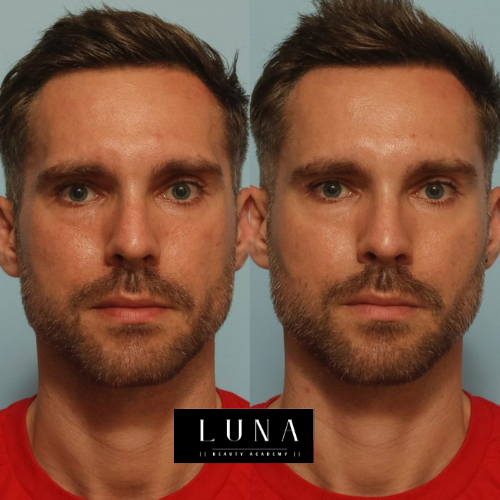 Male Cheek Filler Before and After