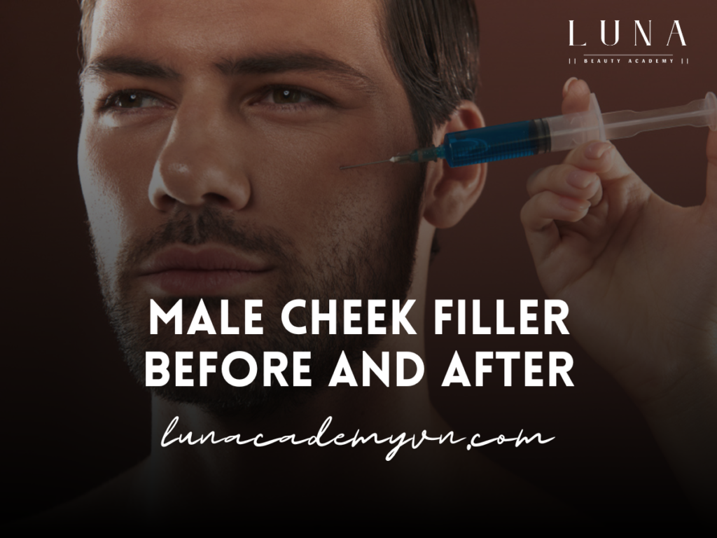 Male cheek filler before and after