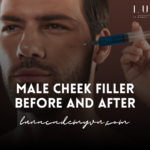 Male cheek filler before and after