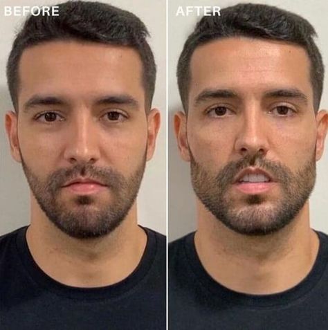 Male Jawline Filler Before and After