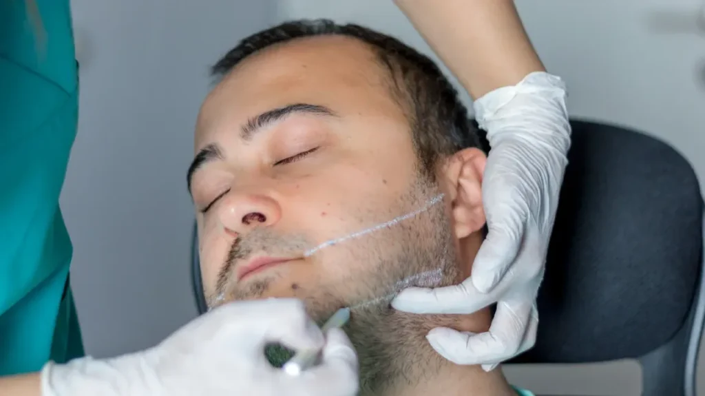 Male Jawline Filler Injection Process