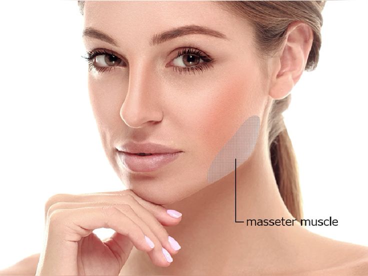 Masseter Botox Results