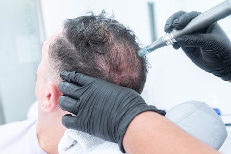 Microneedling After Hair Transplant: A Comprehensive Guide