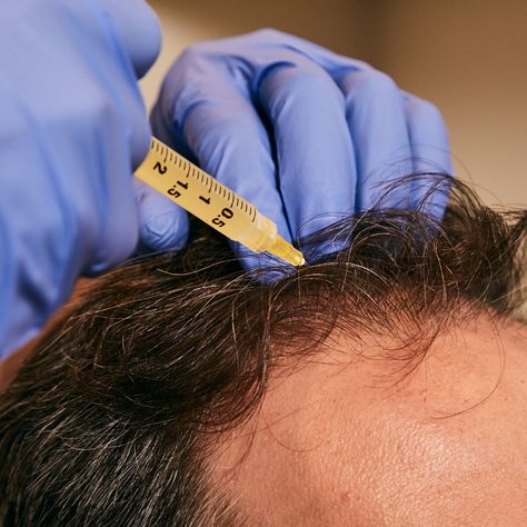 Microneedling After Hair Transplant: A Comprehensive Guide