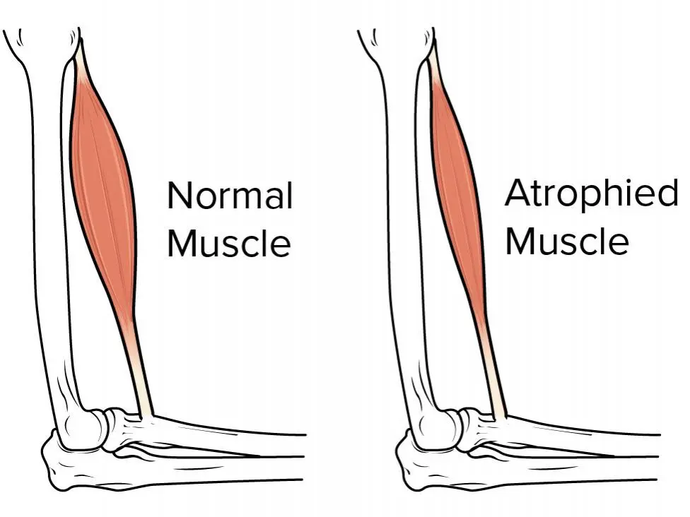 Muscle Atrophy