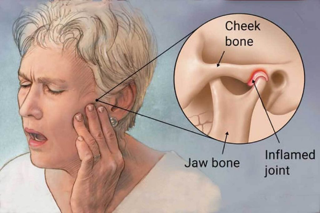 muscle strain jaw and fatigue