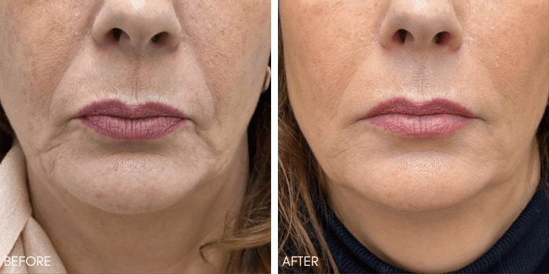 Nasal Fold Fillers Before and After