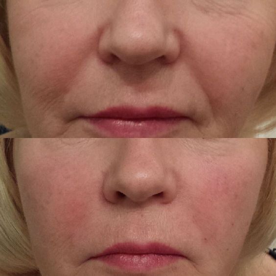 Nasal Folds Filler Before and After Photos