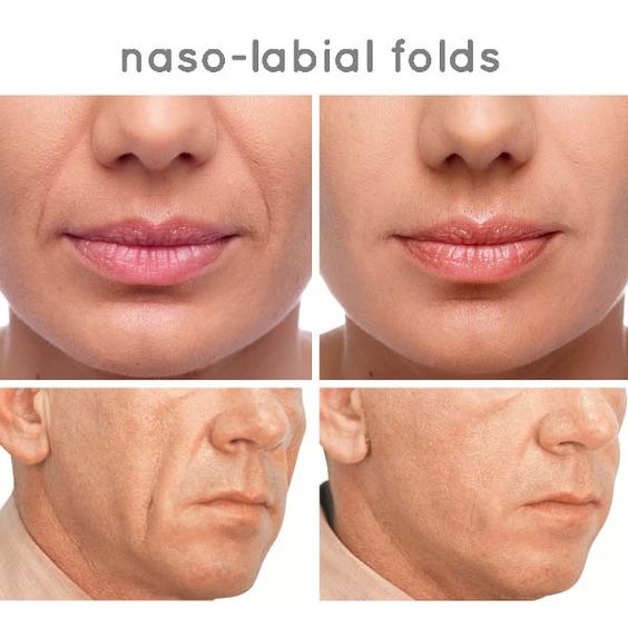 Nasal Folds Filler