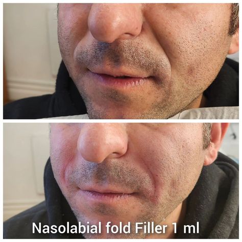 nasolabial fold filler gone wrong