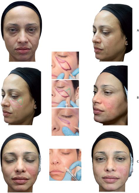 Nasolabial Fold Filler Swelling Stages