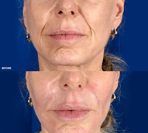 Nasolabial Fold Filler Swelling Stages