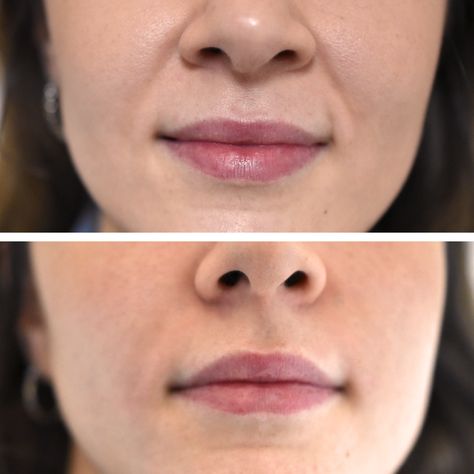 Nasolabial Fold Filler Swelling Stages