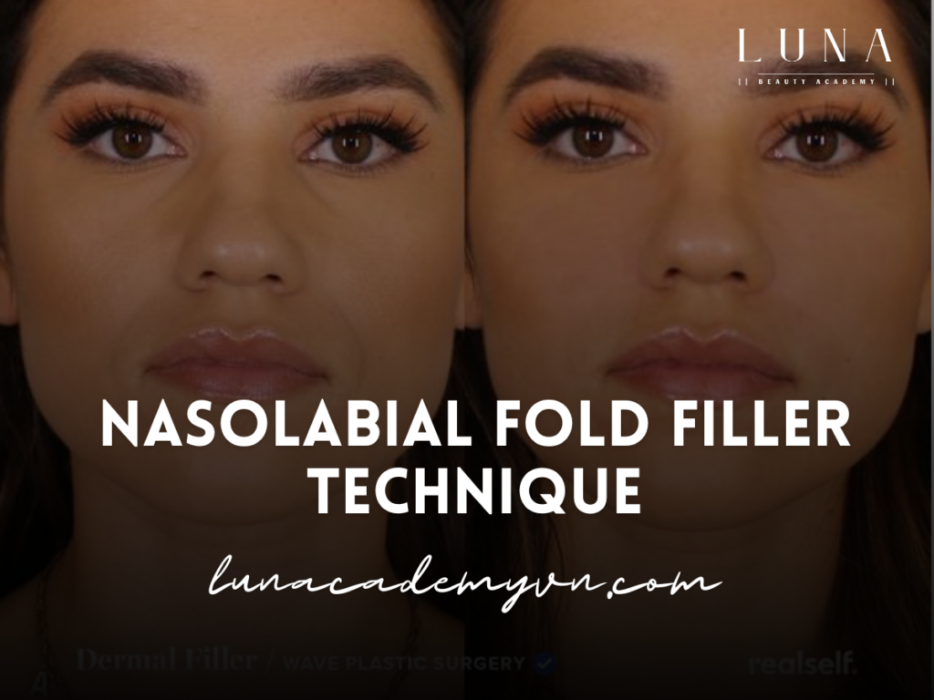 Nasolabial Fold Filler Technique