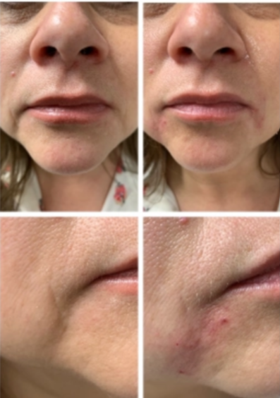 Nasolabial Fold Filler Technique