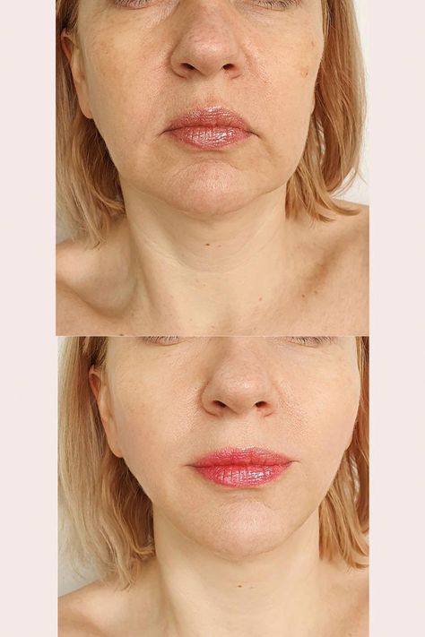 Nasolabial Fold Filler Technique