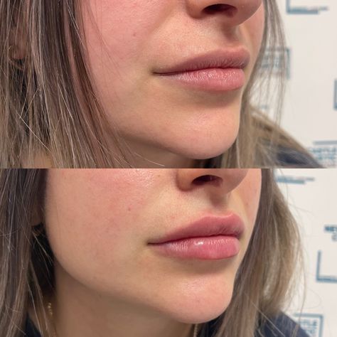 Nasolabial Fold Filler Technique