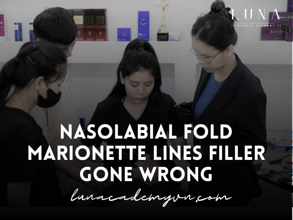 Nasolabial Fold Marionette Lines Filler Gone Wrong