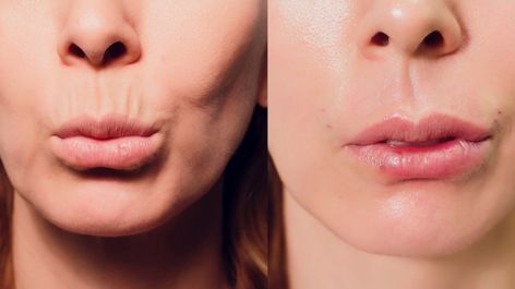 Needle Roller for Lips: A Comprehensive Guide to Lip