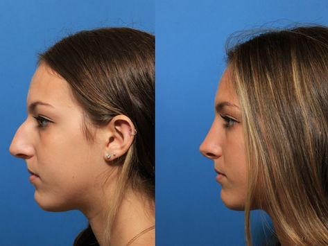 Non Surgical Rhinoplasty Bulbous Tip