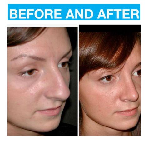 Non Surgical Rhinoplasty Bulbous Tip