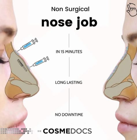 Non Surgical Rhinoplasty Bulbous Tip