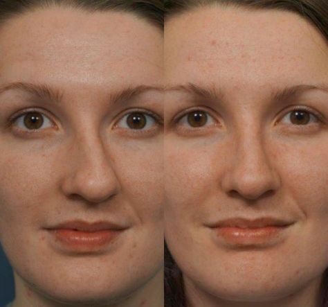 Non Surgical Rhinoplasty Bulbous Tip