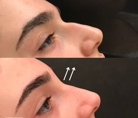 Nose Before and After Results