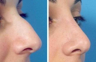 Nose filler cost can range from $600 to $2,500