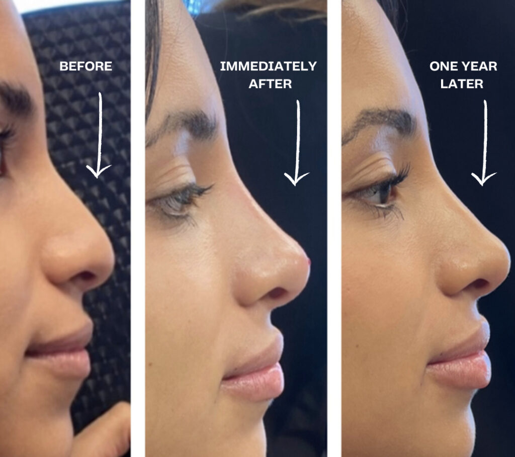  Nose Filler Take to Settle