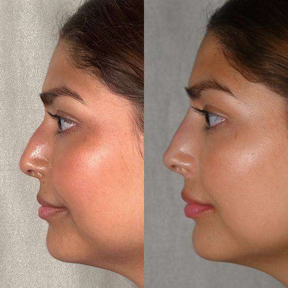 Nose Fillers result 