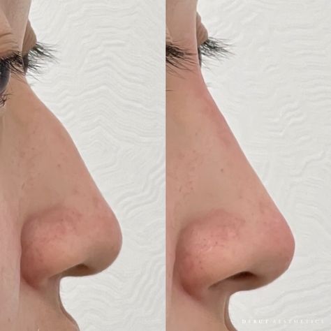 Nose Fillers Side Effects