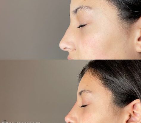 Nose Fillers Side Effects