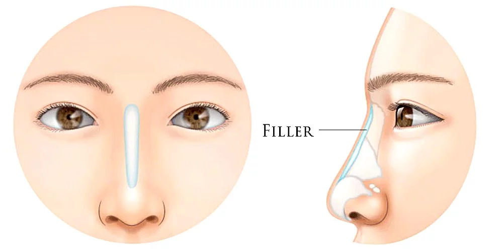  Nose Fillers