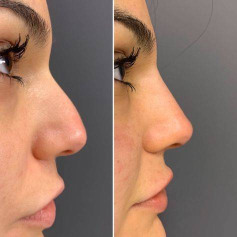 nose lift side effects