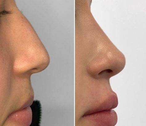 nose lift side effects