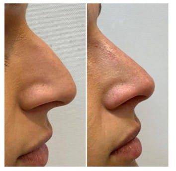 nose lift side effects