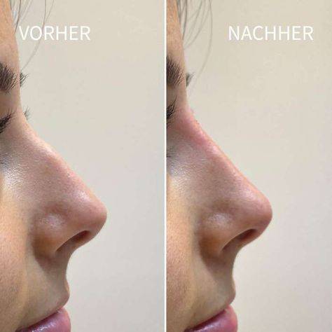 nose lift side effects