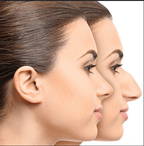 Nose Thread Lift After 2 Years: What You Need to Know