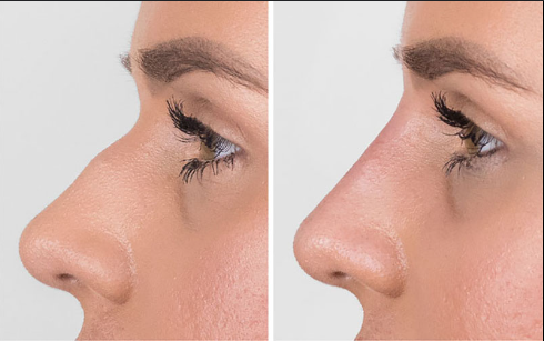 Nose Thread Lift After 2 Years: What You Need to Know