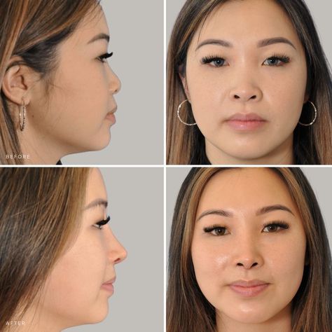 Nose Thread Lift After 2 Years: What You Need to Know