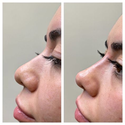 Nose Thread Lift After 2 Years: What You Need to Know