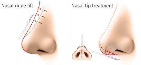 Nose Thread Lift Gone Wrong: Risks and Realities