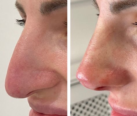 Nose Thread Lift Gone Wrong: Risks and Realities