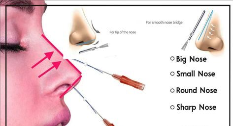 Nose Thread Lift Gone Wrong: Risks and Realities