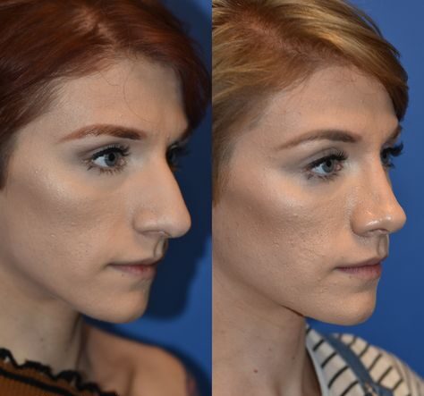 Nose Threads Before and After: Understanding the Transformation