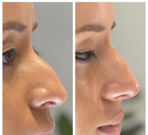 Nose Threads Before and After: Understanding the Transformation