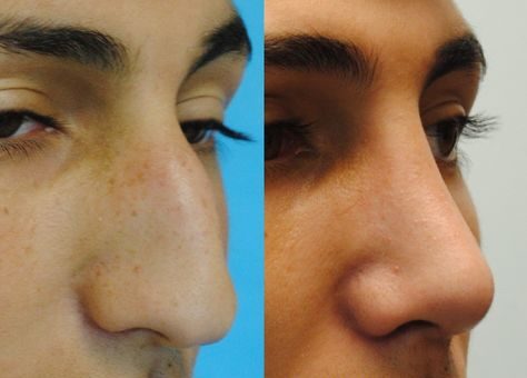 Nose Threads Before and After: Understanding the Transformation