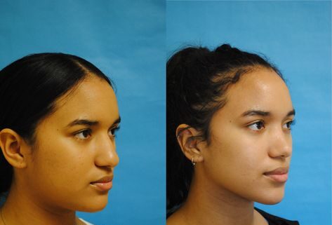 Nose Threads Before and After: Understanding the Transformation